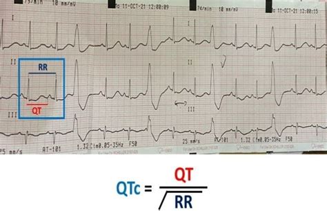 bazzet|Corrected QT Interval (QTc)